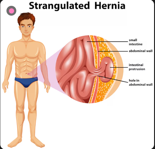 <strong>Best Hernia Surgeon in Dadar</strong>