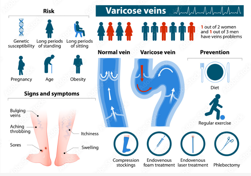 <strong>best varicose veins treatment in Dadar</strong> 